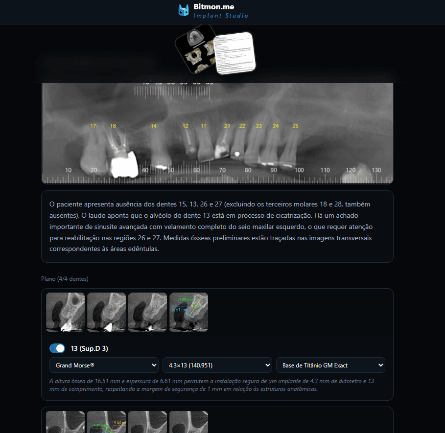 Implant Planning in PDF