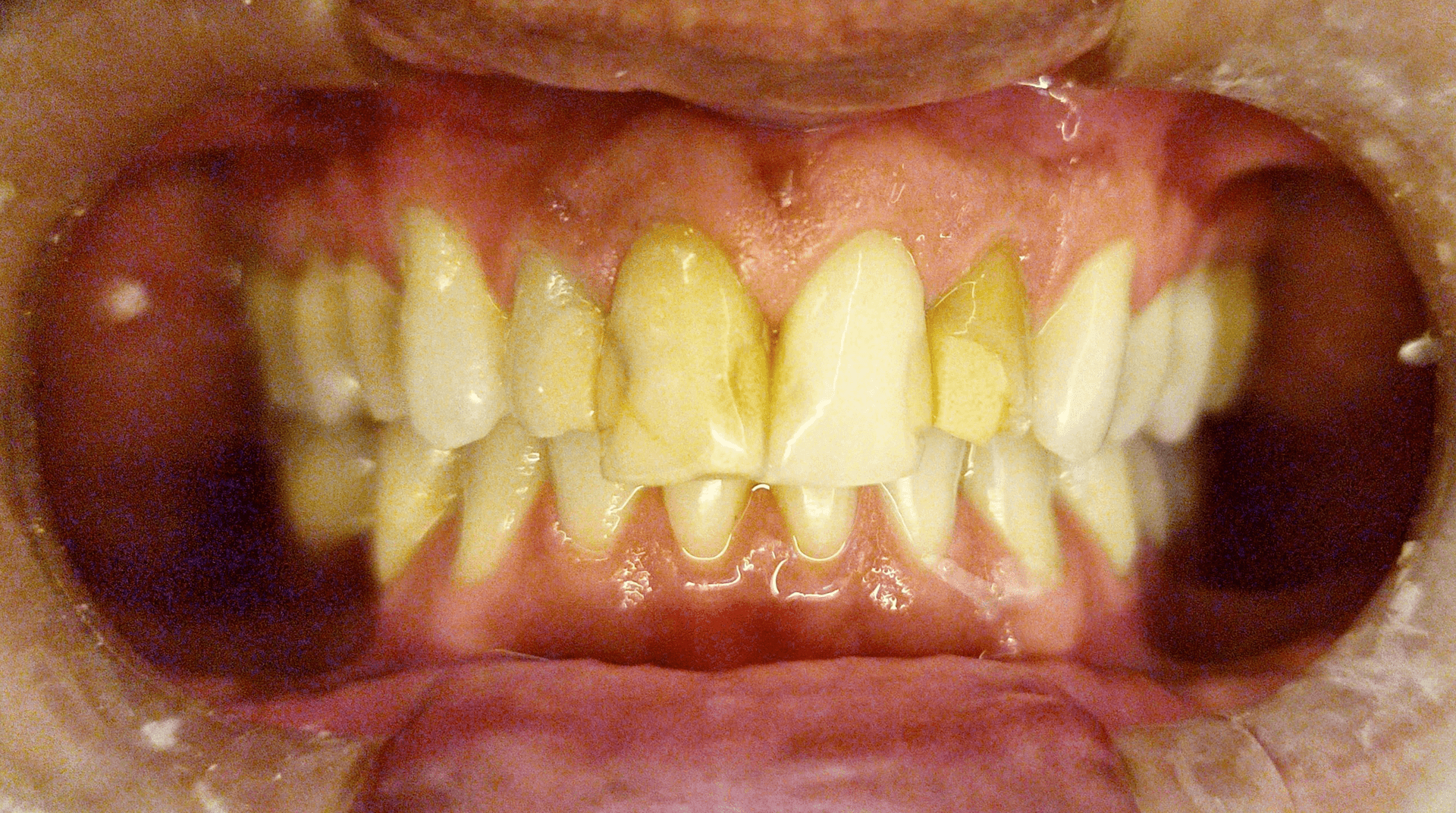 intraoral antes